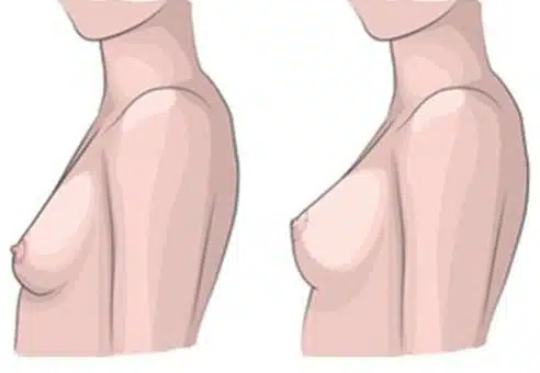 3 tipy, jak na povislá prsa