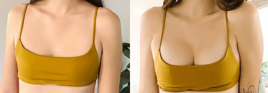 Před a po použití prášků na zvětšení prsou - BreastExtra